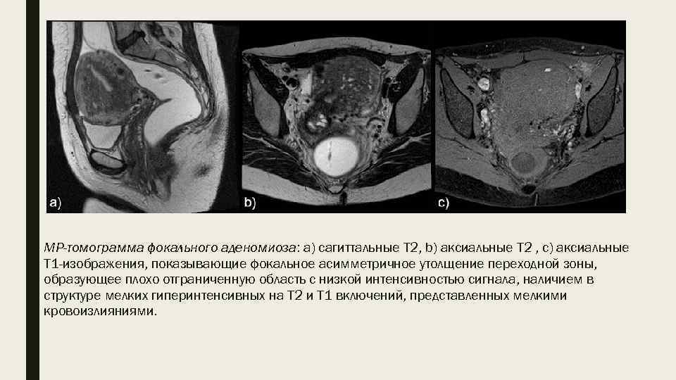 МР-томограмма фокального аденомиоза: а) сагиттальные T 2, b) аксиальные T 2 , с) аксиальные