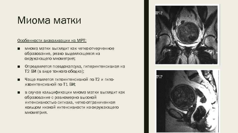 Миома матки Особенности визуализации на МРТ: ■ миома матки выглядит как четко отчерченное образование,