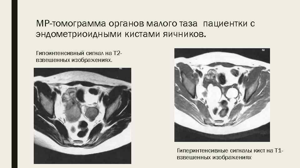 МР-томограмма органов малого таза пациентки с эндометриоидными кистами яичников. Гипоинтенсивный сигнал на Т 2