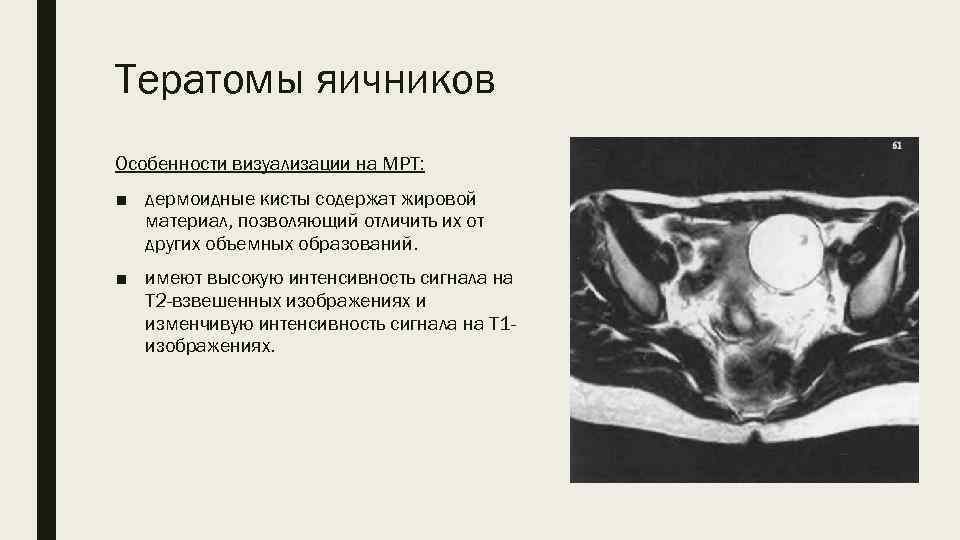 Тератомы яичников Особенности визуализации на МРТ: ■ дермоидные кисты содержат жировой материал, позволяющий отличить