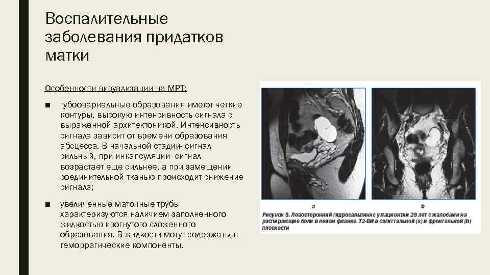 Воспалительные заболевания придатков матки Особенности визуализации на МРТ: ■ тубоовариальные образования имеют четкие контуры,