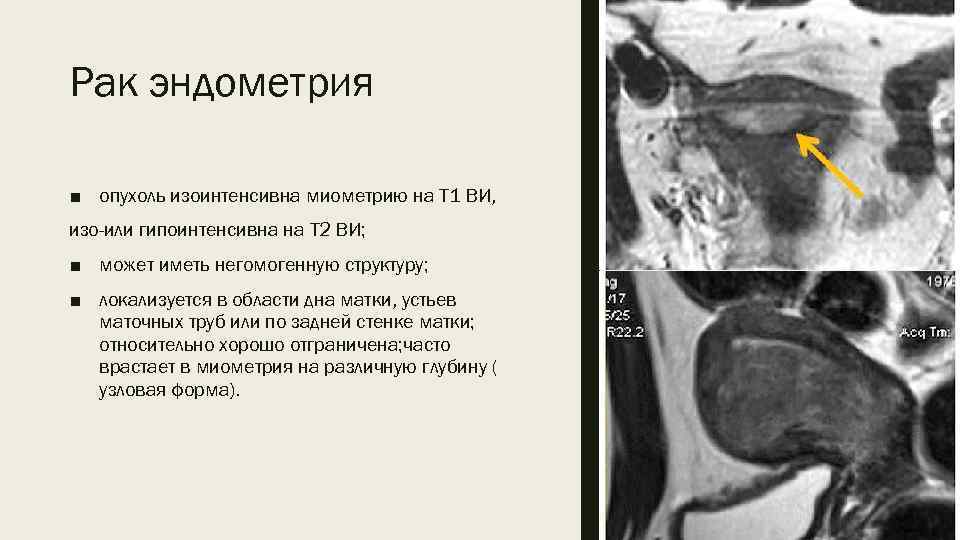 Рак эндометрия ■ опухоль изоинтенсивна миометрию на Т 1 ВИ, изо-или гипоинтенсивна на Т