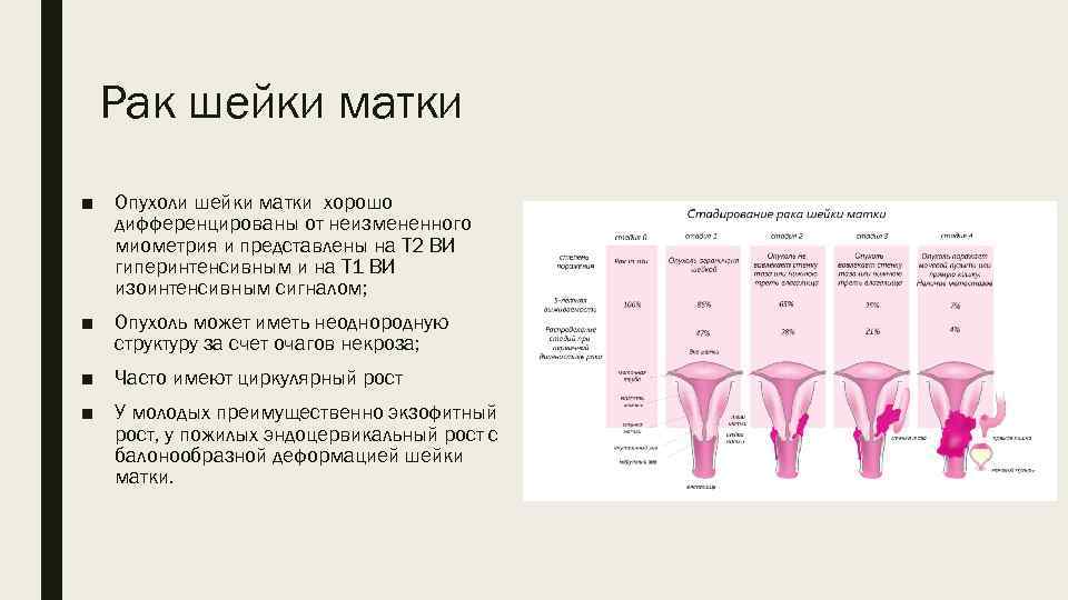 Рак шейки матки ■ Опухоли шейки матки хорошо дифференцированы от неизмененного миометрия и представлены