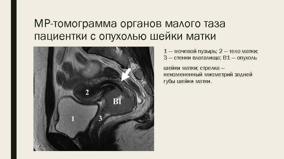 МР-томограмма органов малого таза пациентки с опухолью шейки матки 1 — мочевой пузырь; 2