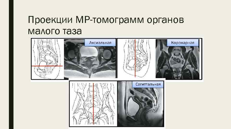 Проекции МР-томограмм органов малого таза 