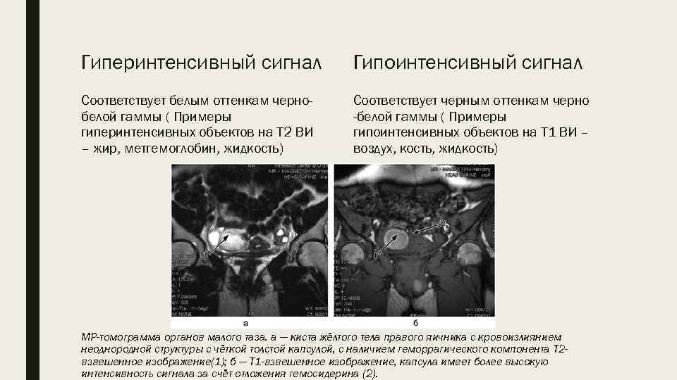 Гиперинтенсивный сигнал Гипоинтенсивный сигнал Соответствует белым оттенкам чернобелой гаммы ( Примеры гиперинтенсивных объектов на