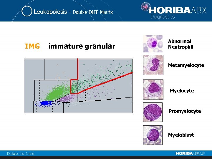 Leukopoïesis - IMG Double DIFF Matrix immature granular Abnormal Neutrophil Metamyelocyte Myelocyte Promyelocyte Myeloblast