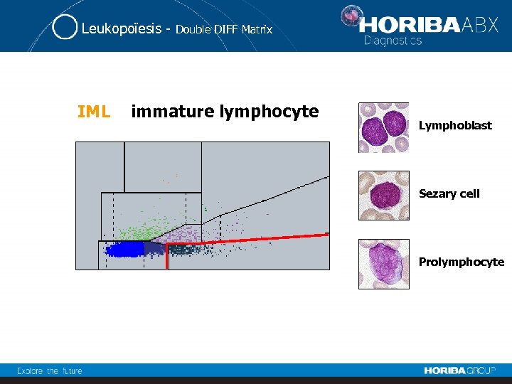 Leukopoïesis - IML Double DIFF Matrix immature lymphocyte Lymphoblast Sezary cell Prolymphocyte 