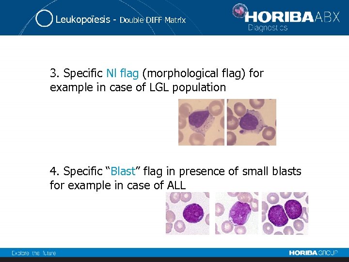 Leukopoïesis - Double DIFF Matrix 3. Specific Nl flag (morphological flag) for example in