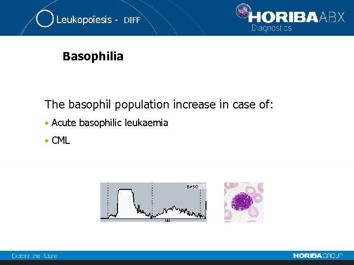 Leukopoïesis - DIFF Basophilia The basophil population increase in case of: • Acute basophilic