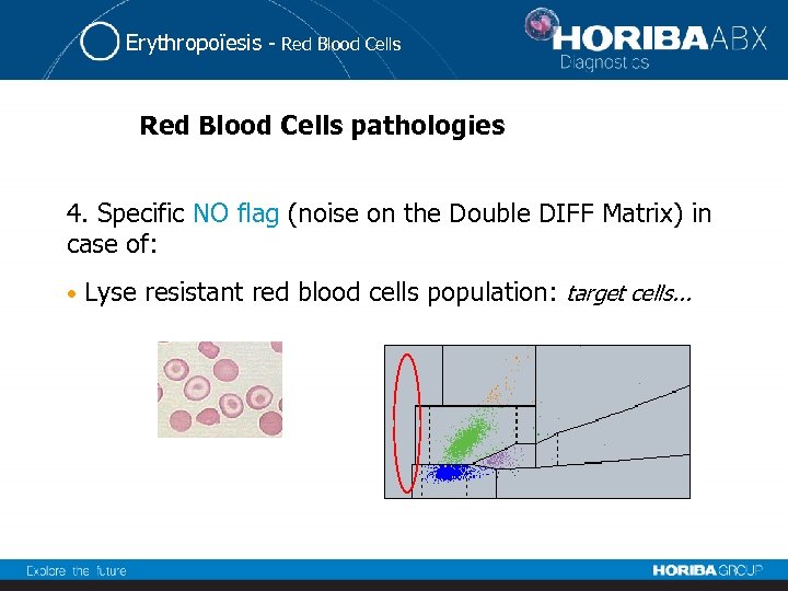 Erythropoïesis - Red Blood Cells pathologies 4. Specific NO flag (noise on the Double