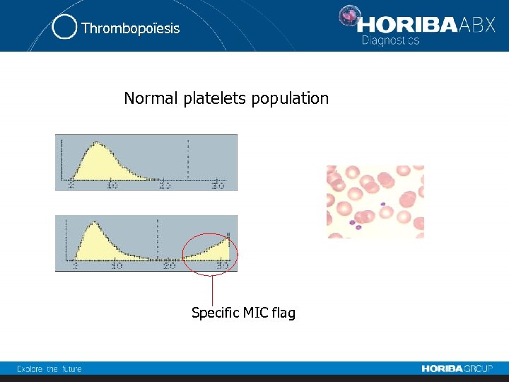 Thrombopoïesis Normal platelets population Specific MIC flag 