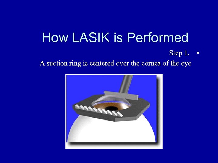 How LASIK is Performed Step 1. • A suction ring is centered over the