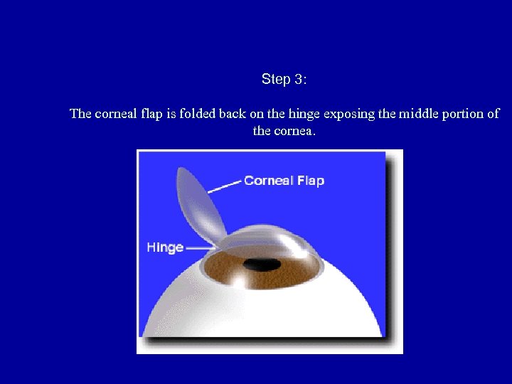 Step 3: The corneal flap is folded back on the hinge exposing the middle