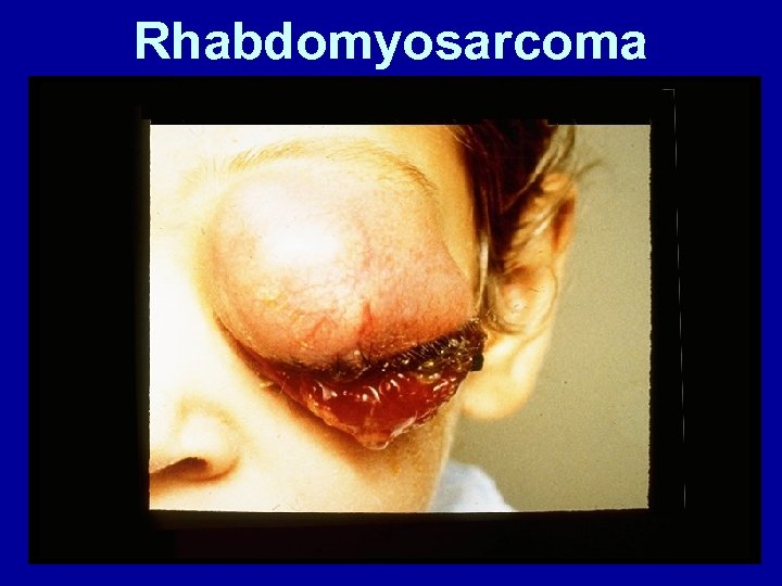Rhabdomyosarcoma 