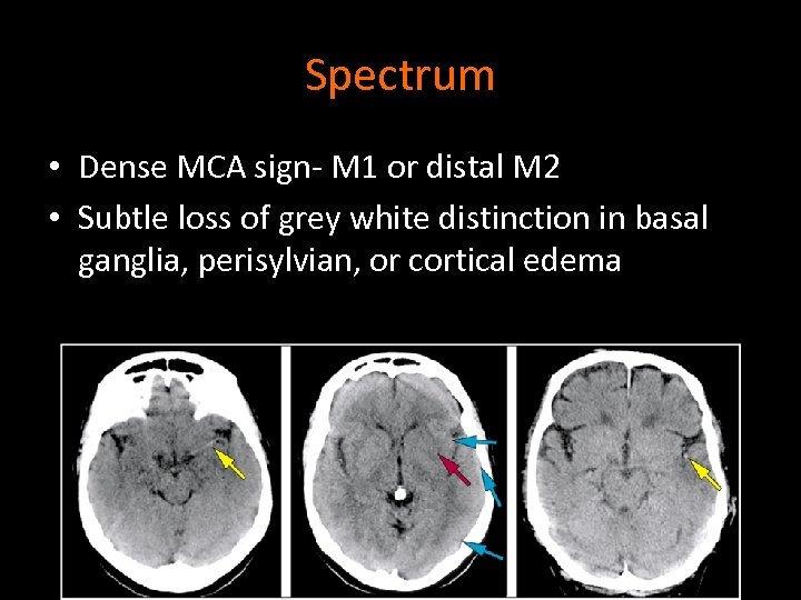 Spectrum • Dense MCA sign- M 1 or distal M 2 • Subtle loss