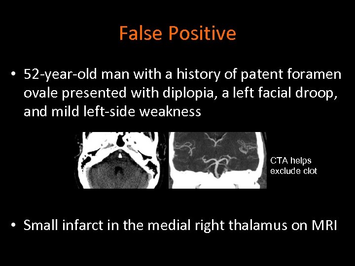 False Positive • 52 -year-old man with a history of patent foramen ovale presented