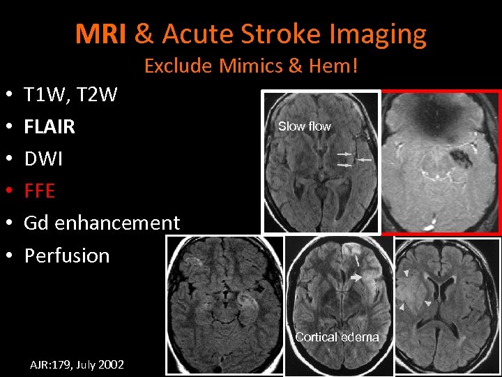 MRI & Acute Stroke Imaging Exclude Mimics & Hem! • • • T 1