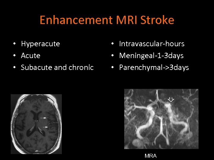 Enhancement MRI Stroke • Hyperacute • Acute • Subacute and chronic • Intravascular-hours •