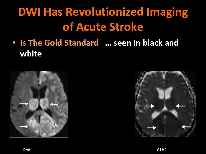 DWI Has Revolutionized Imaging of Acute Stroke • Is The Gold Standard … seen