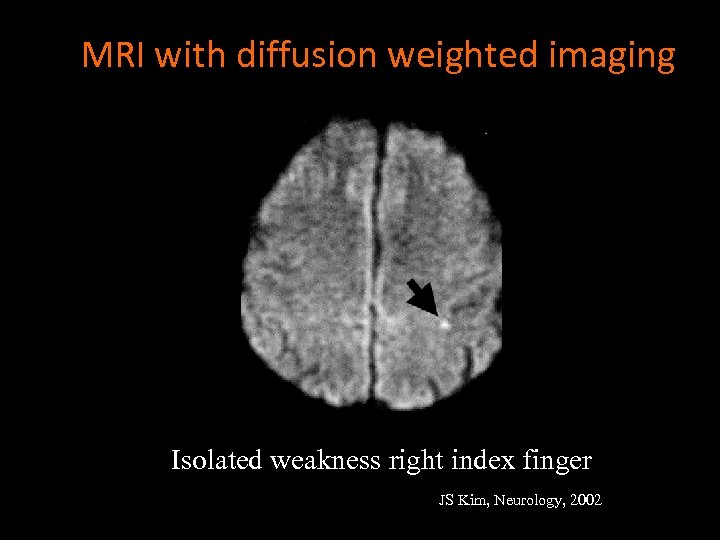 MRI with diffusion weighted imaging Isolated weakness right index finger JS Kim, Neurology, 2002