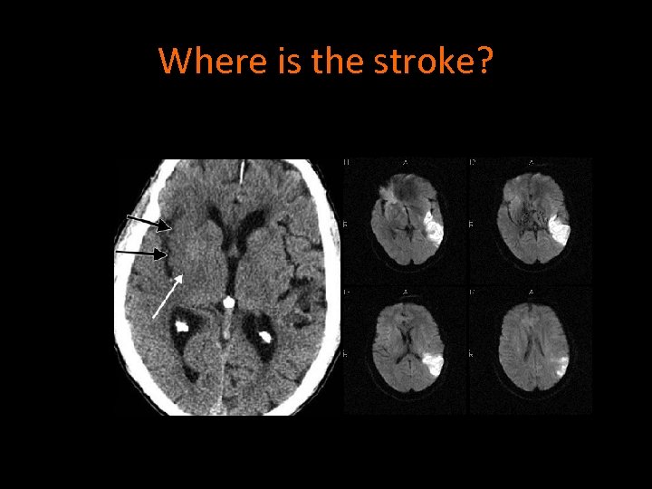 Where is the stroke? 