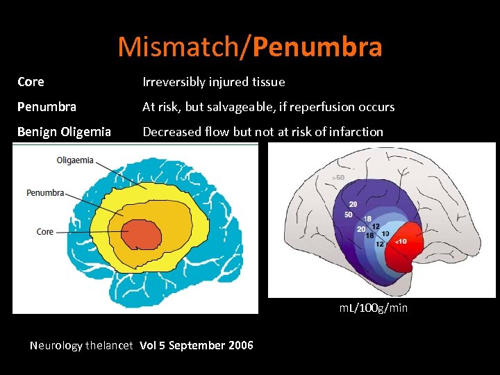 Mismatch/Penumbra Core Irreversibly injured tissue Penumbra At risk, but salvageable, if reperfusion occurs Benign