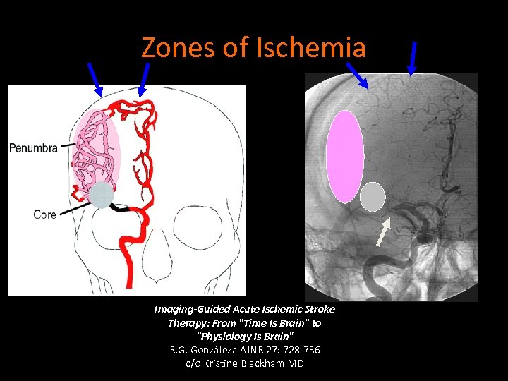 Zones of Ischemia Imaging-Guided Acute Ischemic Stroke Therapy: From 