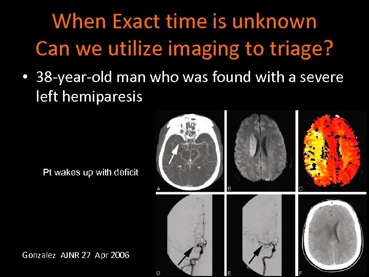 When Exact time is unknown Can we utilize imaging to triage? • 38 -year-old