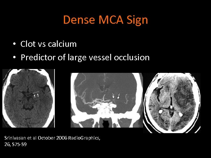 Dense MCA Sign • Clot vs calcium • Predictor of large vessel occlusion Srinivasan