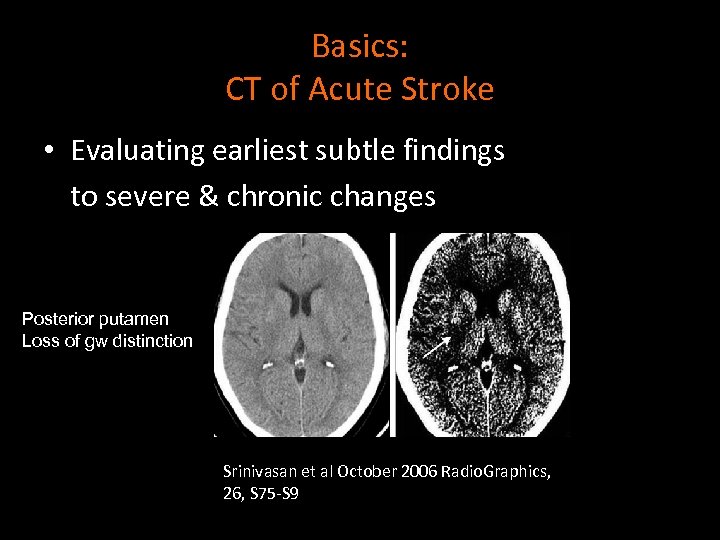 Basics: CT of Acute Stroke • Evaluating earliest subtle findings to severe & chronic