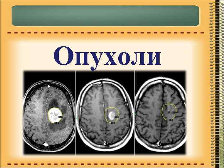 Опухоли 