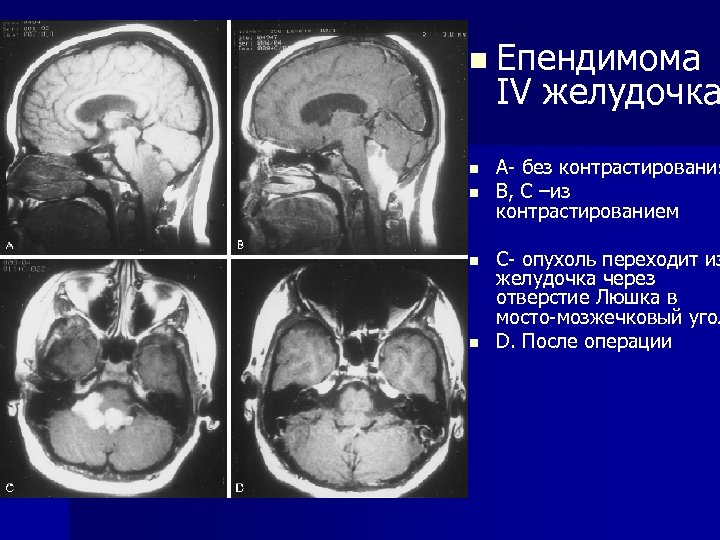 n Епендимома IV желудочка n n А- без контрастирования В, C –из контрастированием С-