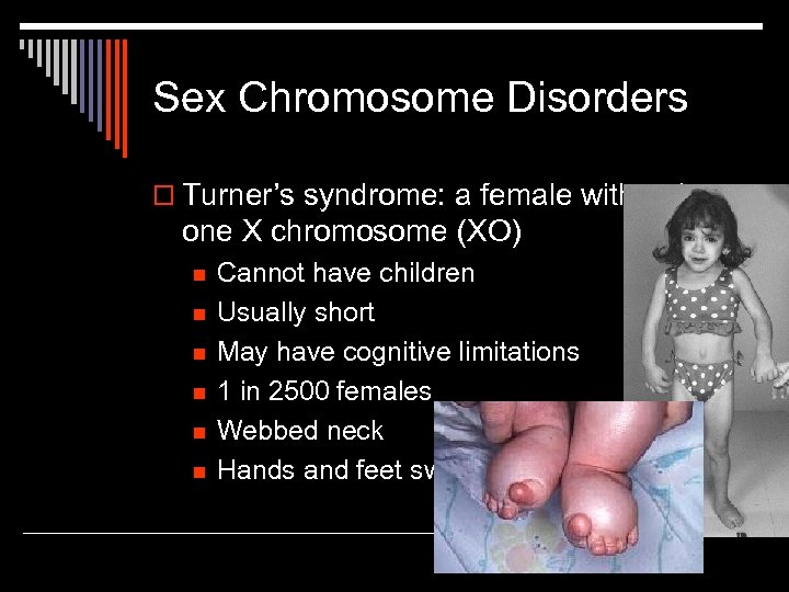 Sex Chromosome Disorders o Turner’s syndrome: a female with only one X chromosome (XO)