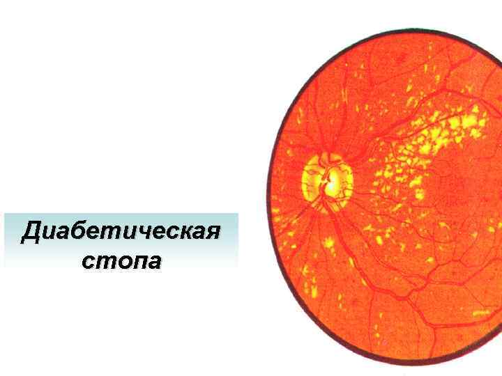 Диабетическая стопа 