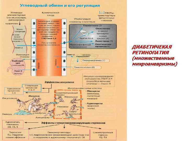 ДИАБЕТИЧЕКАЯ РЕТИНОПАТИЯ (множественные микроаневризмы) 