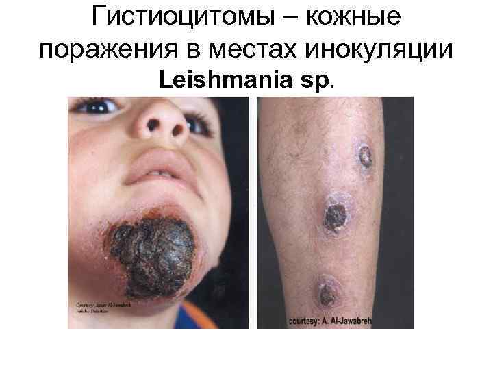 Гистиоцитомы – кожные поражения в местах инокуляции Leishmania sp. 