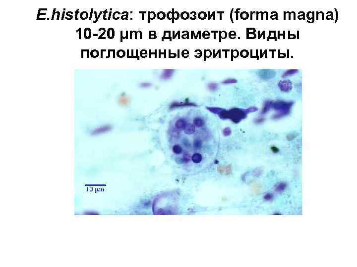 E. histolytica: трофозоит (forma magna) 10 -20 µm в диаметре. Видны поглощенные эритроциты. 