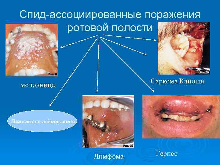 Лейкоплакия ротовой полости фото