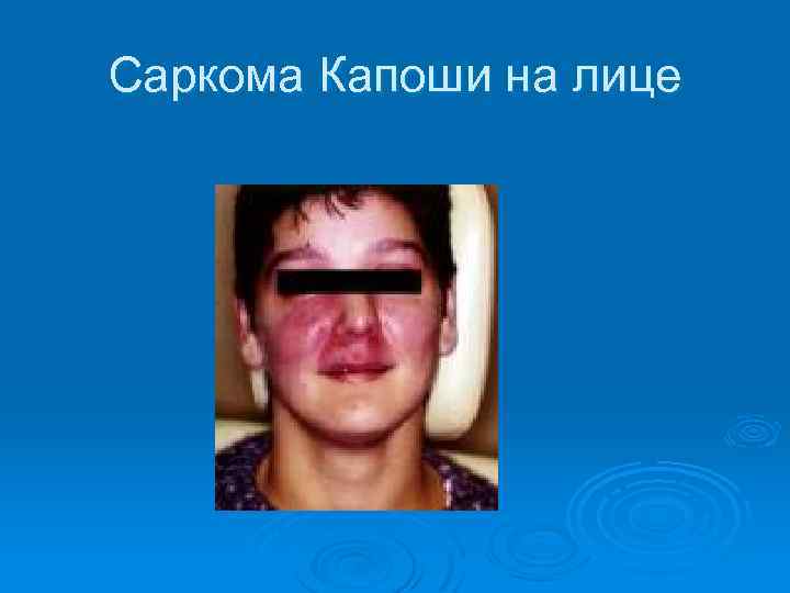 Саркома Капоши на лице 