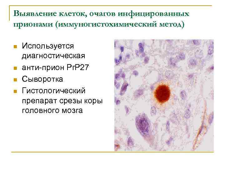 Выявление клеток, очагов инфицированных прионами (иммуногистохимический метод) n n Используется диагностическая анти-прион Pr. P