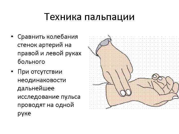 Техника пальпации • Сравнить колебания стенок артерий на правой и левой руках больного •