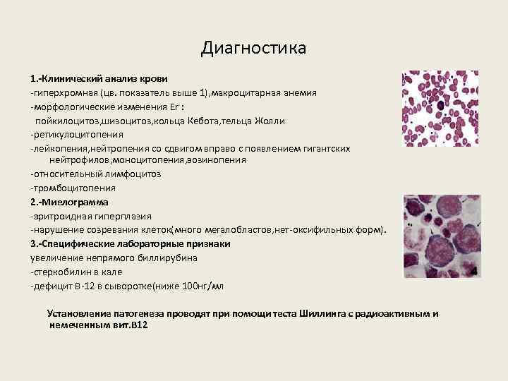 Диагностика 1. -Клинический анализ крови -гиперхромная (цв. показатель выше 1), макроцитарная анемия -морфологические изменения