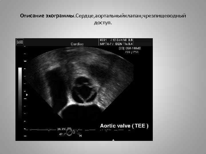 Описание эхограммы. Сердце, аортальныйклапан, чрезпищеводный доступ. 