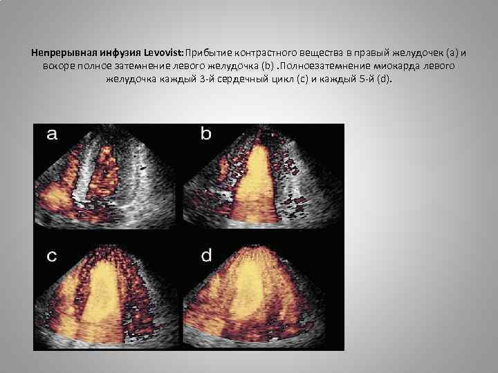Непрерывная инфузия Levovist: Прибытие контрастного вещества в правый желудочек (a) и вскоре полное затемнение