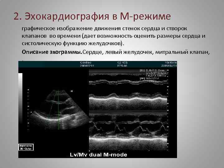 2. Эхокардиография в М-режиме графическое изображение движения стенок сердца и створок клапанов во времени