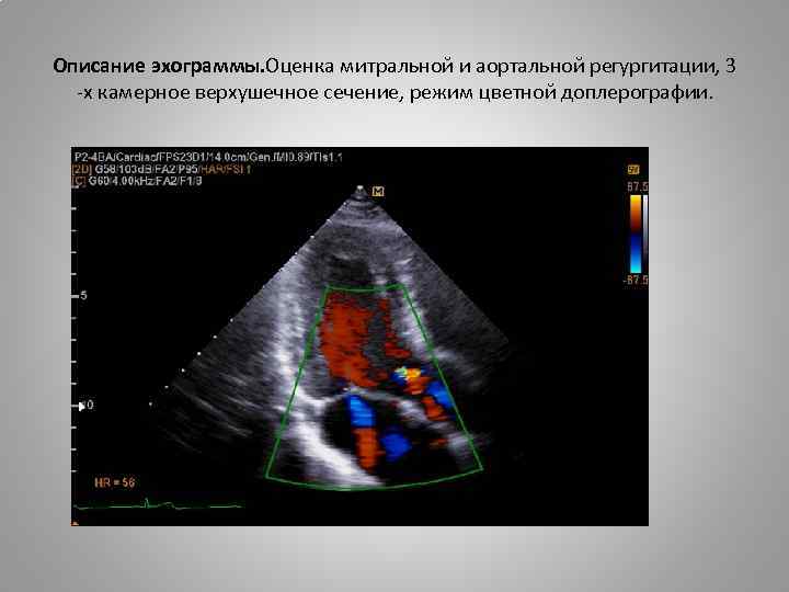  Описание эхограммы. Оценка митральной и аортальной регургитации, 3 -х камерное верхушечное сечение, режим