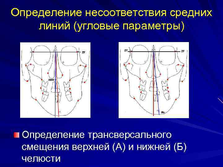 Определение несоответствия средних линий (угловые параметры) Определение трансверсального смещения верхней (А) и нижней (Б)