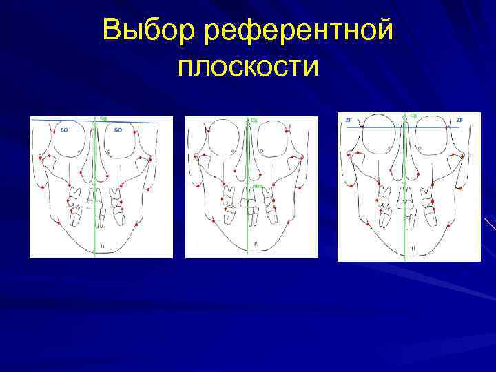 Выбор референтной плоскости 