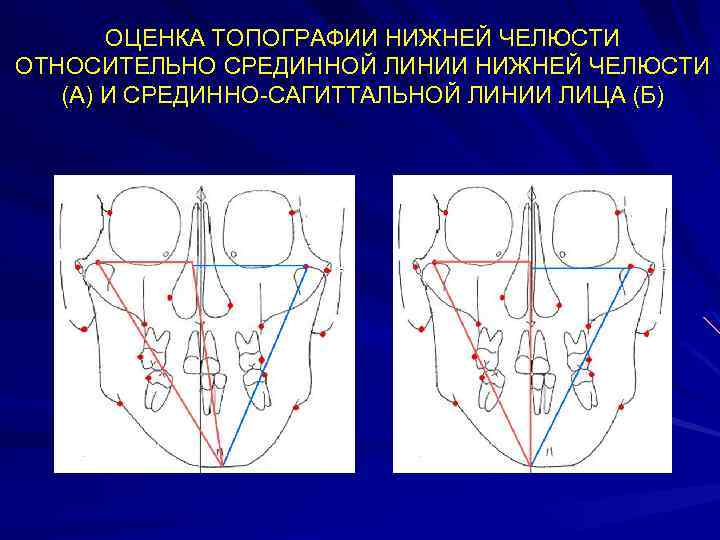 ОЦЕНКА ТОПОГРАФИИ НИЖНЕЙ ЧЕЛЮСТИ ОТНОСИТЕЛЬНО СРЕДИННОЙ ЛИНИИ НИЖНЕЙ ЧЕЛЮСТИ (А) И СРЕДИННО-САГИТТАЛЬНОЙ ЛИНИИ ЛИЦА